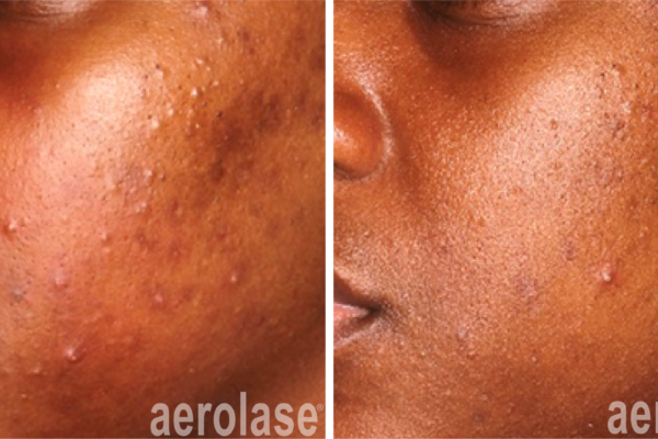 aerolase-before-after-michelle-henry-4-treatments aerolase-before-after-michelle-henry-4-treatments