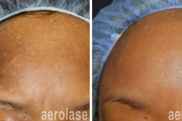 aerolase-melasma-before-after-cheryl-burgess-1-treatment aerolase-melasma-before-after-cheryl-burgess-1-treatment