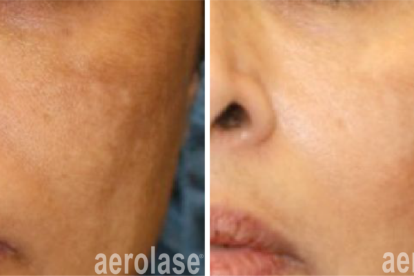 aerolase-neoskin-melasma-after-1-treatment-cheryl-burgess aerolase-neoskin-melasma-after-1-treatment-cheryl-burgess