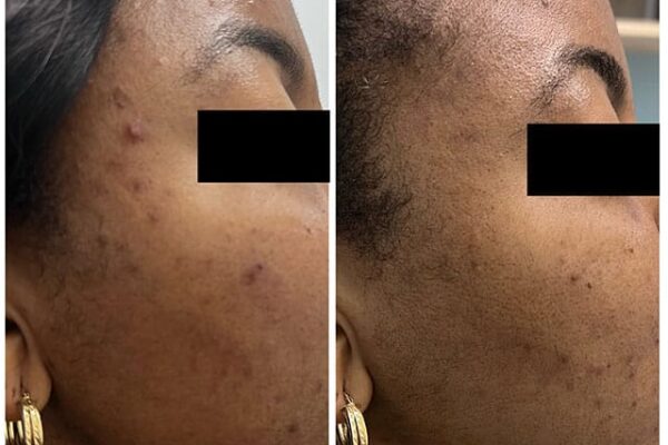 aerolase-1-2 aerolase-1-2