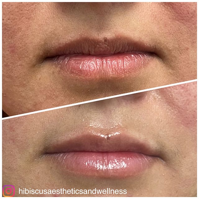 lip-filler-3