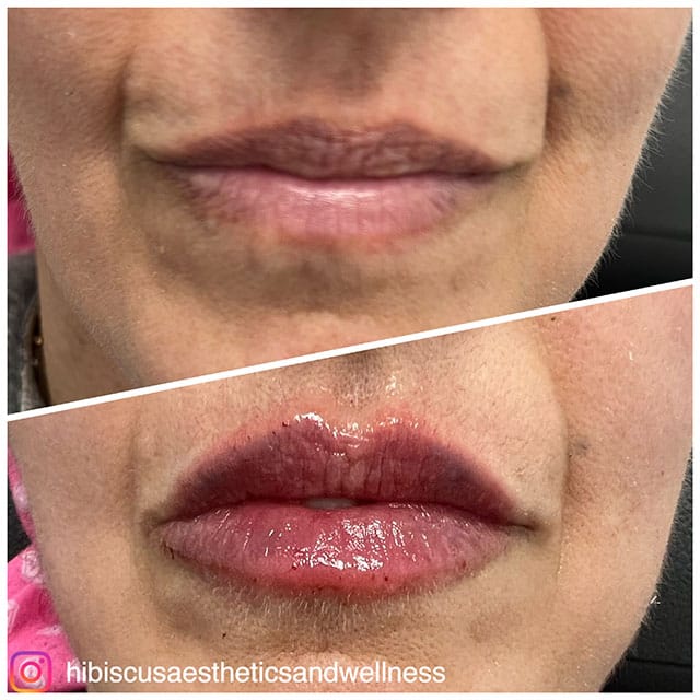 lip-filler-4