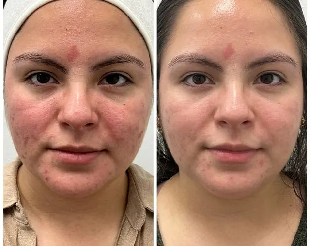 Before and after Acne treatment, result 1, at Hibiscus Aesthetics & Wellness, Katy TX