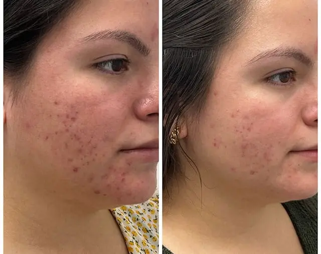 Before and after Acne treatment, result 2, at Hibiscus Aesthetics & Wellness, Katy TX