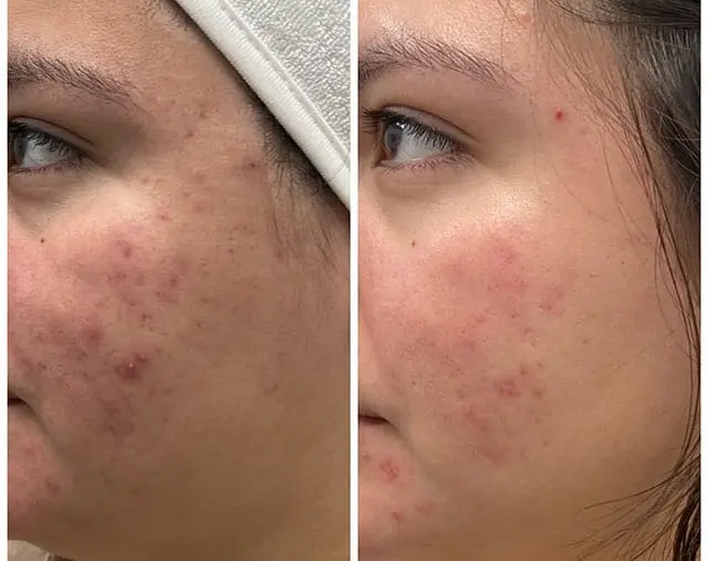Before and after Acne treatment, result 4, at Hibiscus Aesthetics & Wellness, Katy TX