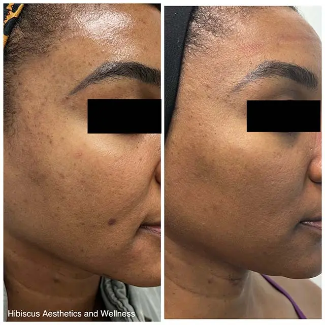 Before and after Aerolase treatment, result 2, at Hibiscus Aesthetics & Wellness, Katy TX