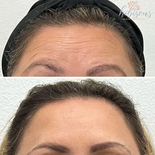 Before and after Neurotoxin treatment, result 8, at Hibiscus Aesthetics & Wellness, Katy TX