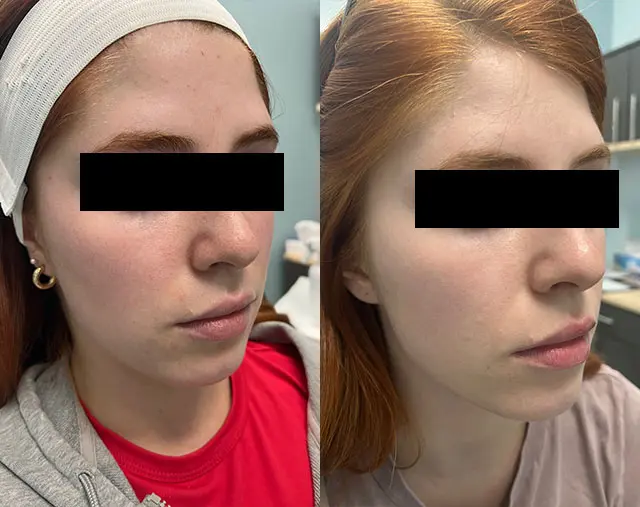 Before and after Microneedling treatment, result 2, at Hibiscus Aesthetics & Wellness, Katy TX