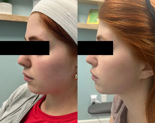 Before and after Microneedling treatment, result 3, at Hibiscus Aesthetics & Wellness, Katy TX