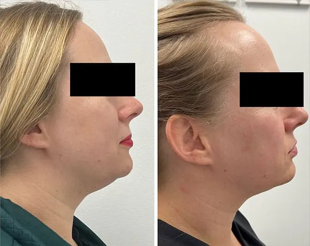 Before and after Kybella treatment, result 1, at Hibiscus Aesthetics & Wellness, Katy TX