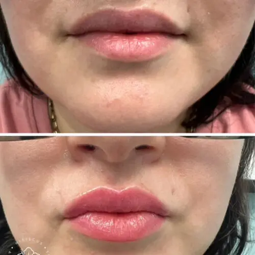 Before and after Lip Filler treatment, result 1, at Hibiscus Aesthetics & Wellness, Katy TX