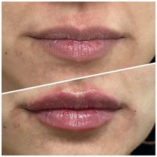 Before and after Lip Filler treatment, result 8, at Hibiscus Aesthetics & Wellness, Katy TX