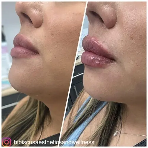 Before and after Lip Filler treatment, result 7, at Hibiscus Aesthetics & Wellness, Katy TX