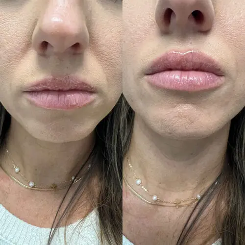 Before and after Lip Filler treatment, result 6, at Hibiscus Aesthetics & Wellness, Katy TX