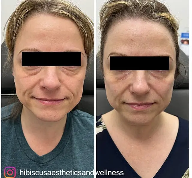 Before and after PRF treatment, result 1, at Hibiscus Aesthetics & Wellness, Katy TX